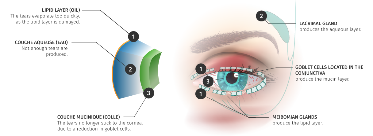 Dry eye - Diagnose or treat your dry eye